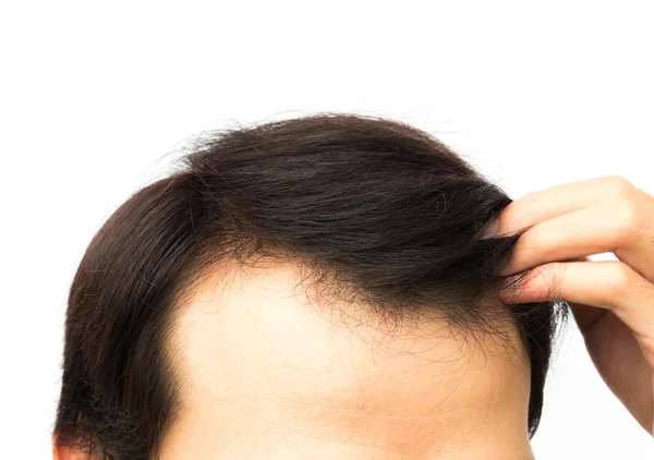 Closeup young man serious hair loss problem for hair loss concept — Stock Photo, Image