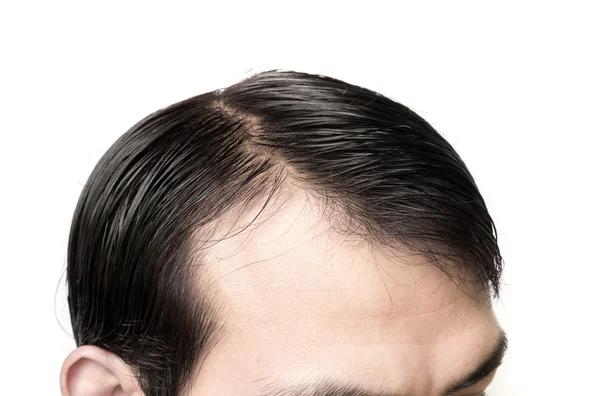 근접 촬영 젊은 남자 머리 손실 개념에 대 한 심각한 탈모 증의 문제 — 스톡 사진