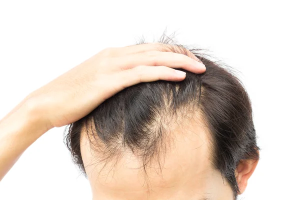 Jovem homem grave problema de perda de cabelo para o problema de perda de cabelo para haelth cuidado shampoo e ser o conceito do produto — Fotografia de Stock