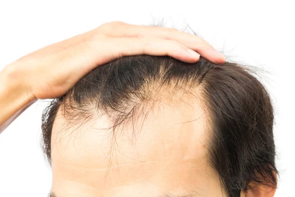 Closeup young man serious hair loss problem for hair loss concept — Stock Photo, Image