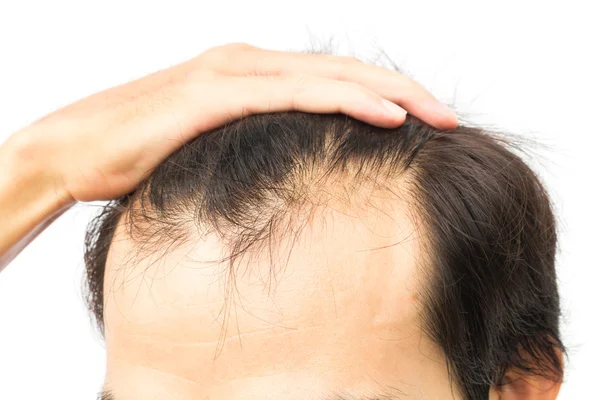 Closeup jovem homem grave problema de perda de cabelo para o conceito de perda de cabelo — Fotografia de Stock