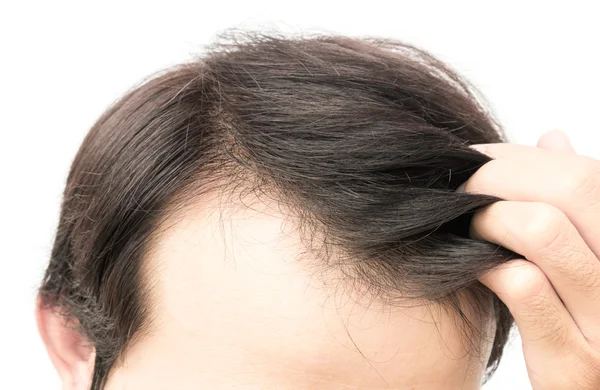 Крупный план молодой человек серьезная проблема выпадения волос для здравоохранения шампунь и косметический продукт концепции — стоковое фото