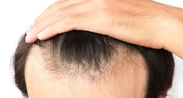 Joven hombre serio problema de pérdida de cabello para el concepto de pérdida de cabello — Foto de Stock