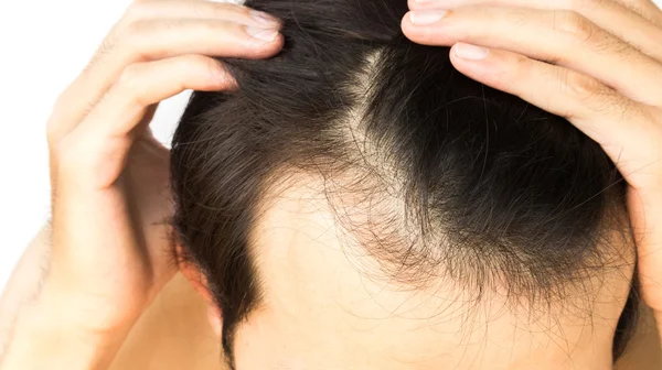 Молодой человек серьезная проблема выпадения волос для концепции выпадения волос — стоковое фото
