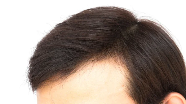 Giovane uomo grave problema di perdita di capelli per concetto di perdita di capelli — Foto Stock