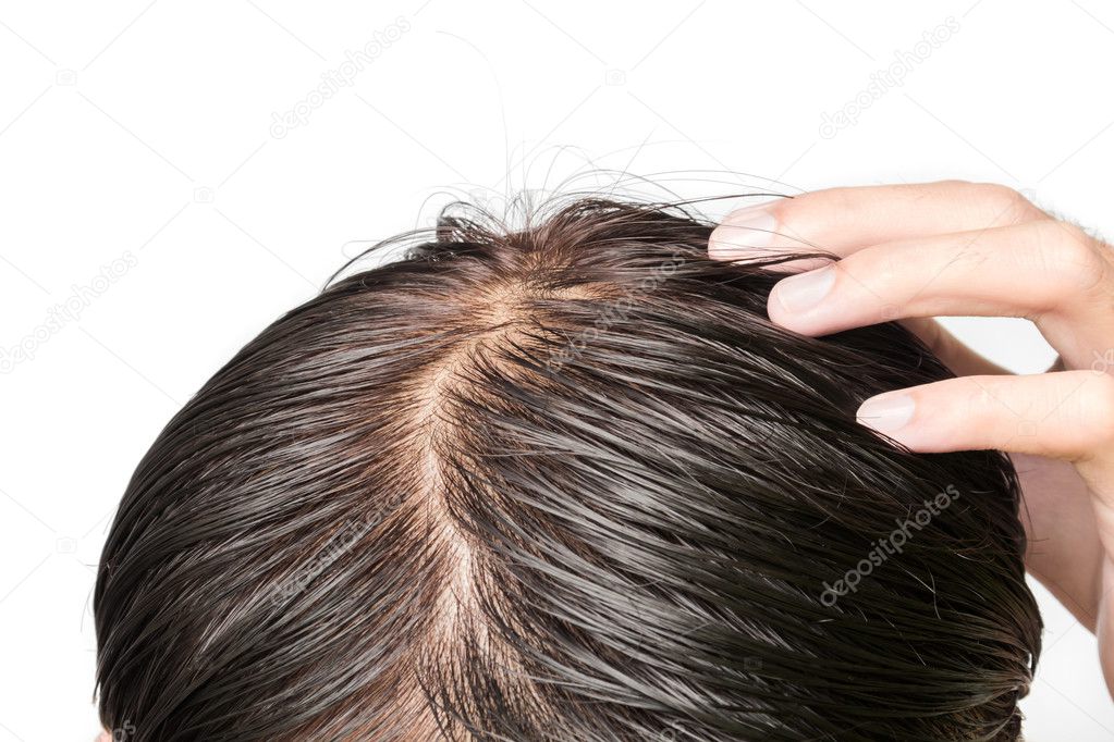 Closeup young man serious hair loss problem for hair loss concept