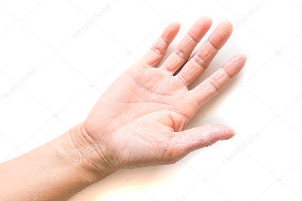 Hand atopic dermatitis symptom skin texture on white background