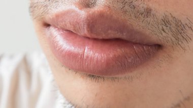 Tatlı dudaklar adam sorun sağlık hizmetlerinin, Herpes simpleks