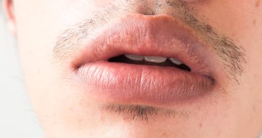 Tatlı dudaklar adam sorun sağlık hizmetlerinin, Herpes simpleks