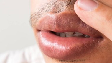 Tatlı dudaklar adam sorun sağlık hizmetlerinin, Herpes simpleks