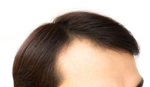 Ung man allvarligt hår förlust problem för hälso-och schampo och skönhet produktkoncept — Stockfoto