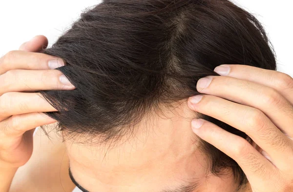 Jeune homme grave problème de perte de cheveux pour les soins de santé shampooing et produit de beauté concept — Photo