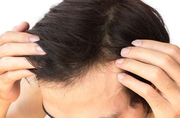 Joven hombre serio problema de pérdida de cabello para el cuidado de la salud champú y concepto de producto de belleza —  Fotos de Stock