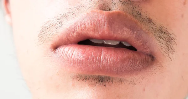 Gros plan des lèvres homme problème soins de santé, Herpes simplex — Photo