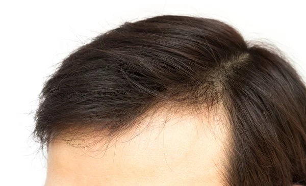 Närbild ung man allvarliga hår förlust problem för hår förlust koncept — Stockfoto