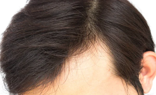 Closeup jovem homem grave problema de perda de cabelo para o conceito de perda de cabelo — Fotografia de Stock