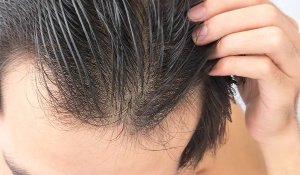 Giovane uomo grave problema di perdita di capelli per concetto di perdita di capelli — Foto Stock