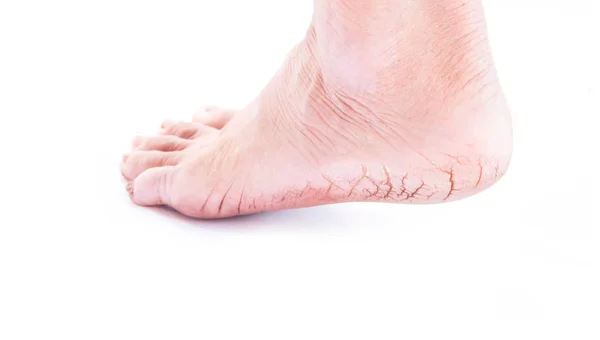 Woman cracked heels with white background, foot healthy concept — Stock Photo, Image