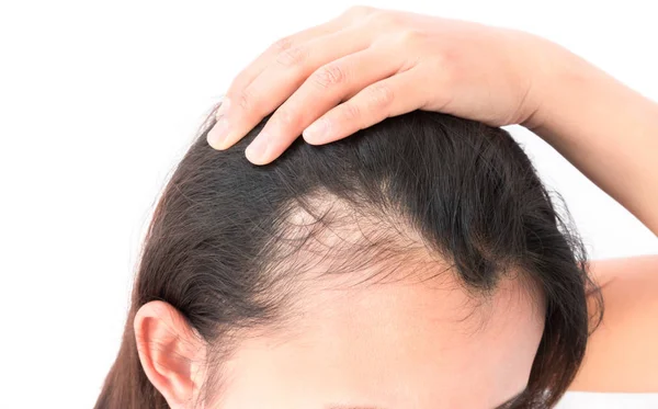 Mujer grave problema de pérdida de cabello para el cuidado de la salud champú y concepto de producto de belleza — Foto de Stock