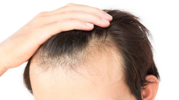 Jeune homme s'inquiètent problème de perte de cheveux pour les soins de santé shampooing et produit de beauté concept — Photo