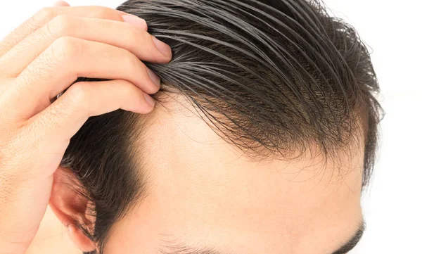 Joven hombre preocupado problema de pérdida de cabello para el cuidado de la salud champú y concepto de producto de belleza — Foto de Stock