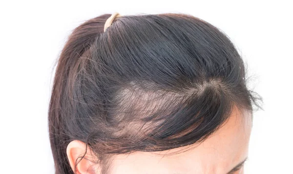 Donna grave problema di perdita dei capelli per shampoo sanitario e concetto di prodotto di bellezza — Foto Stock