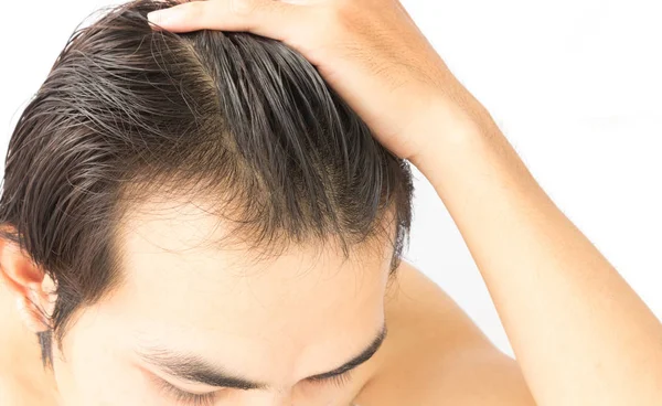 Nahaufnahme junger Mann schwerwiegende Haarausfall Problem für Gesundheitsversorgung Mogelpackung — Stockfoto