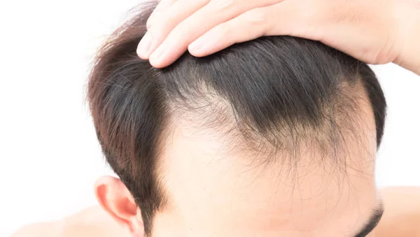 Joven hombre preocupado problema de pérdida de cabello para el cuidado de la salud champú y concepto de producto de belleza — Foto de Stock