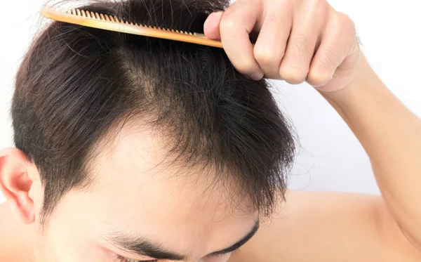 Young man worry hair loss problem for health care shampoo and be — Stock Photo, Image