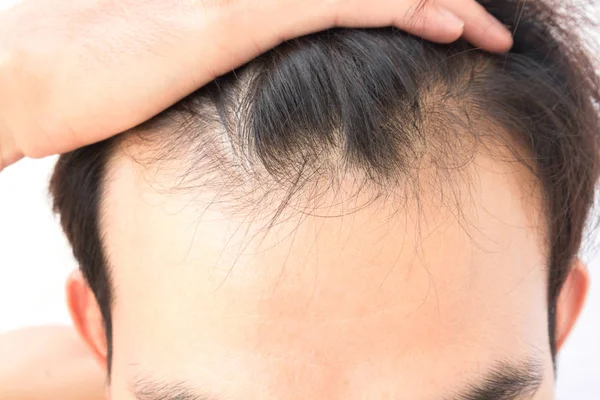 Молодой человек беспокоиться проблемы выпадения волос для здравоохранения шампунь и концепция косметического продукта — стоковое фото