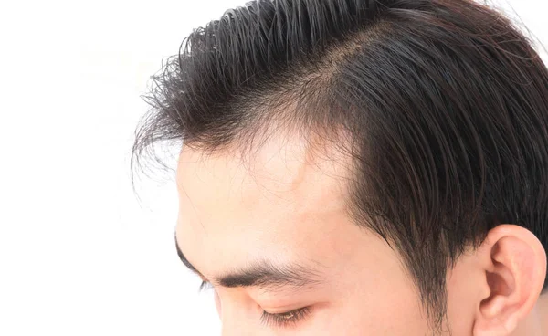 Anak muda khawatir kehilangan rambut masalah untuk shampo perawatan kesehatan dan menjadi — Stok Foto