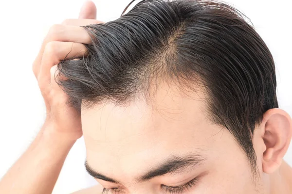 Mladý muž starosti problém vypadávání vlasů pro zdravotní péče šampon a — Stock fotografie