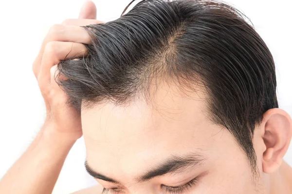 Young man worry hair loss problem for health care shampoo and be — Stock Photo, Image