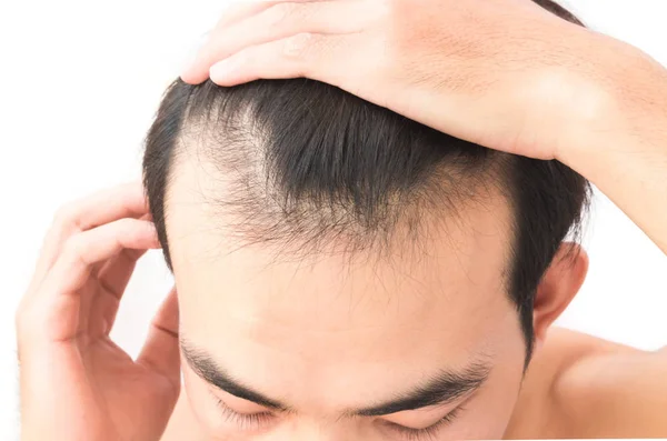 Jovem preocupação problema de perda de cabelo para shampoo cuidados de saúde e conceito de produto de beleza — Fotografia de Stock