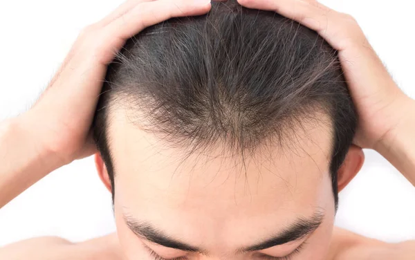 Giovane problema di perdita di capelli preoccupazione per shampoo di assistenza sanitaria e concetto di prodotto di bellezza — Foto Stock