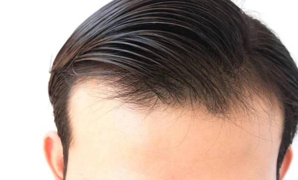 Junger Mann sorgt sich um Haarausfall-Problem für Gesundheitsshampoo und Beauty-Produktkonzept — Stockfoto