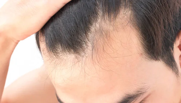 Joven hombre preocupado problema de pérdida de cabello para el cuidado de la salud champú y concepto de producto de belleza —  Fotos de Stock