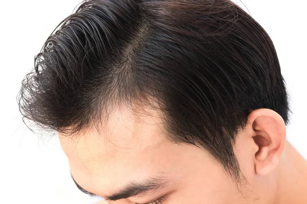 Joven hombre preocupado problema de pérdida de cabello para el cuidado de la salud champú y concepto de producto de belleza — Foto de Stock