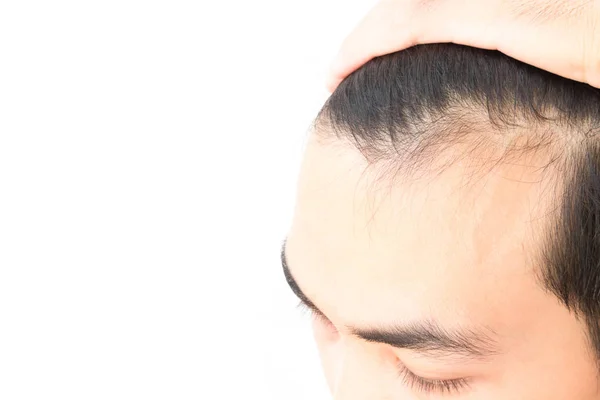 Молодий чоловік турбується про проблеми випадіння волосся для охорони здоров'я шампунь і концепцію косметичного продукту — стокове фото