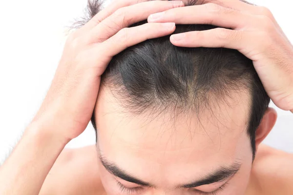 Молодий чоловік турбується про проблеми випадіння волосся для охорони здоров'я шампунь і концепцію косметичного продукту — стокове фото