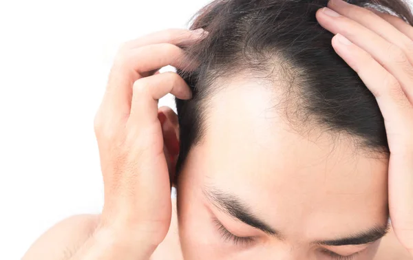 Young man worry hair loss problem for health care shampoo and beauty product concept — Stock Photo, Image