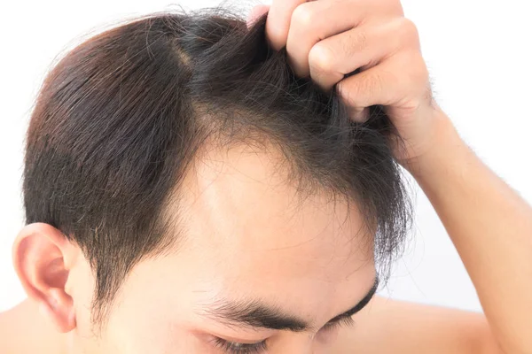 Junger Mann sorgt sich um Haarausfall-Problem für Gesundheitsshampoo und Beauty-Produktkonzept — Stockfoto
