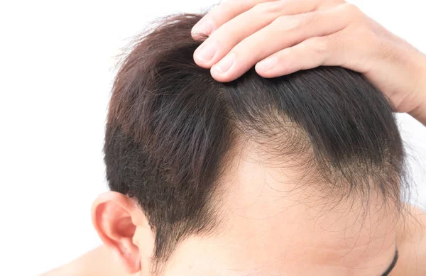 Νεαρός άνδρας ανησυχείτε πρόβλημα απώλειας μαλλιών για υγειονομική περίθαλψη σαμπουάν και προϊόντων ομορφιάς, η οποία — Φωτογραφία Αρχείου