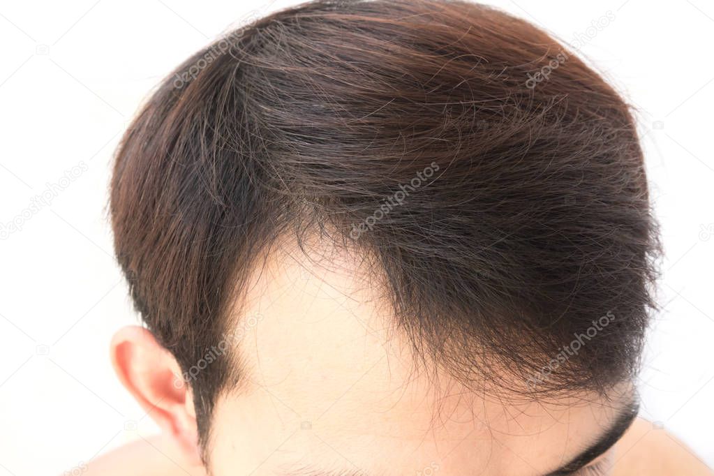 Young man worry hair loss problem for health care shampoo and beauty product concept