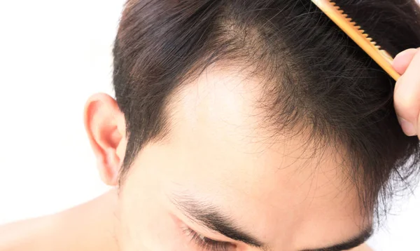 Joven hombre serio problema de pérdida de cabello para el champú de atención médica y —  Fotos de Stock