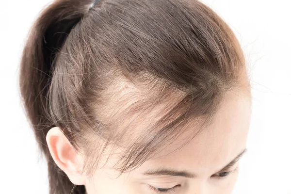 Mujer grave problema de pérdida de cabello — Foto de Stock