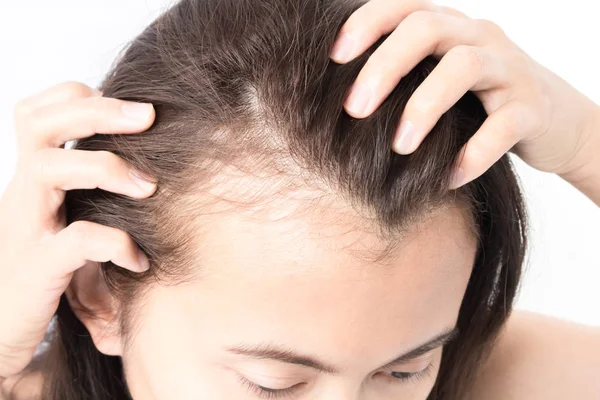 Donna grave problema di perdita dei capelli per shampoo sanitario e concetto di prodotto di bellezza — Foto Stock