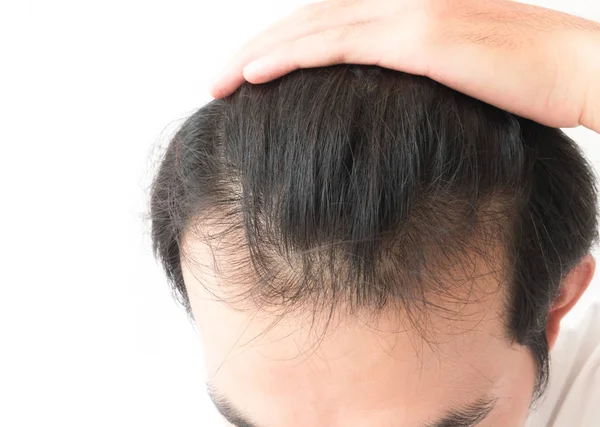 Mladý muž vážné vlasy ztráta problém pro zdravotní péče šampon a — Stock fotografie