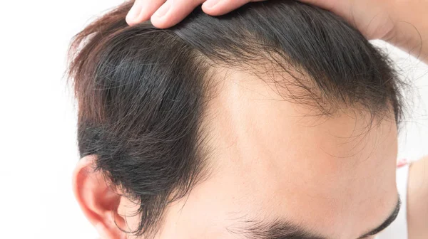 Joven hombre serio problema de pérdida de cabello para el champú de atención médica y — Foto de Stock