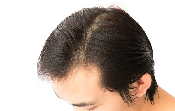 Joven hombre serio problema de pérdida de cabello para el cuidado de la salud champú y concepto de producto de belleza — Foto de Stock